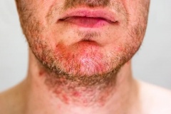 Себорейний дерматит – хронічний запальний стан шкіри