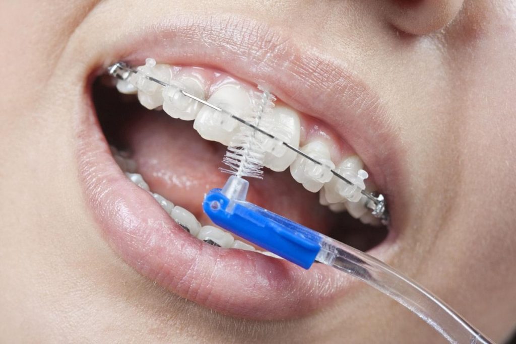 чистка зубов с брекетами