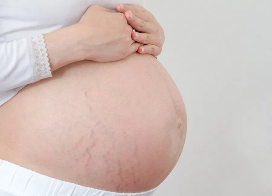 Розтяжки при вагітності – результат відсутності нормального синтезування білків