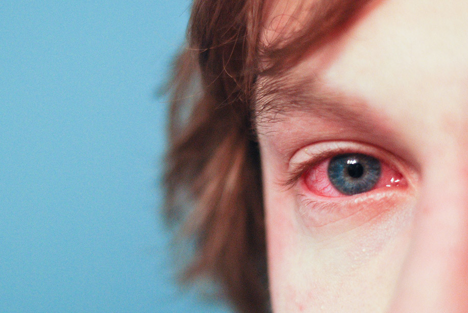 Сонячна алергія на очах