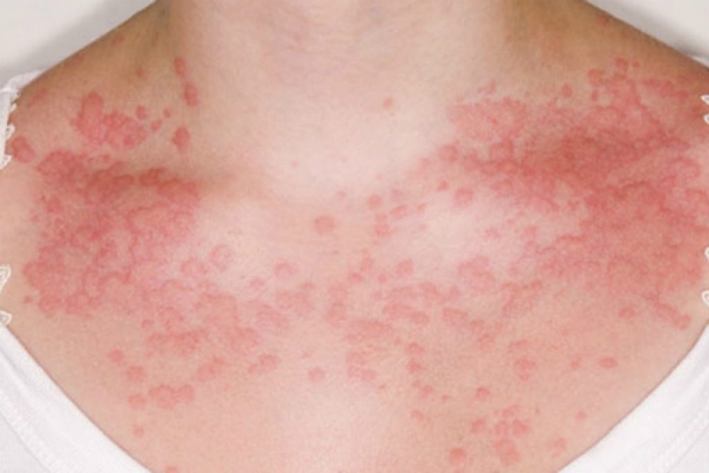 Так виглядає шкіра з симптомами сонячної алергії