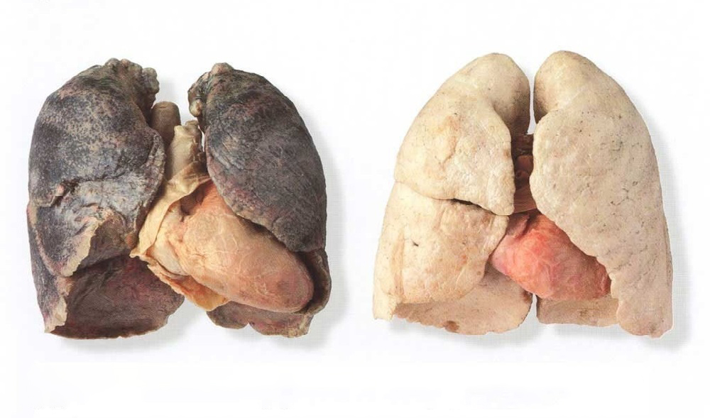 Праворуч — легені курця, зліва — здорової людини. Ще не хочете кинути курити?