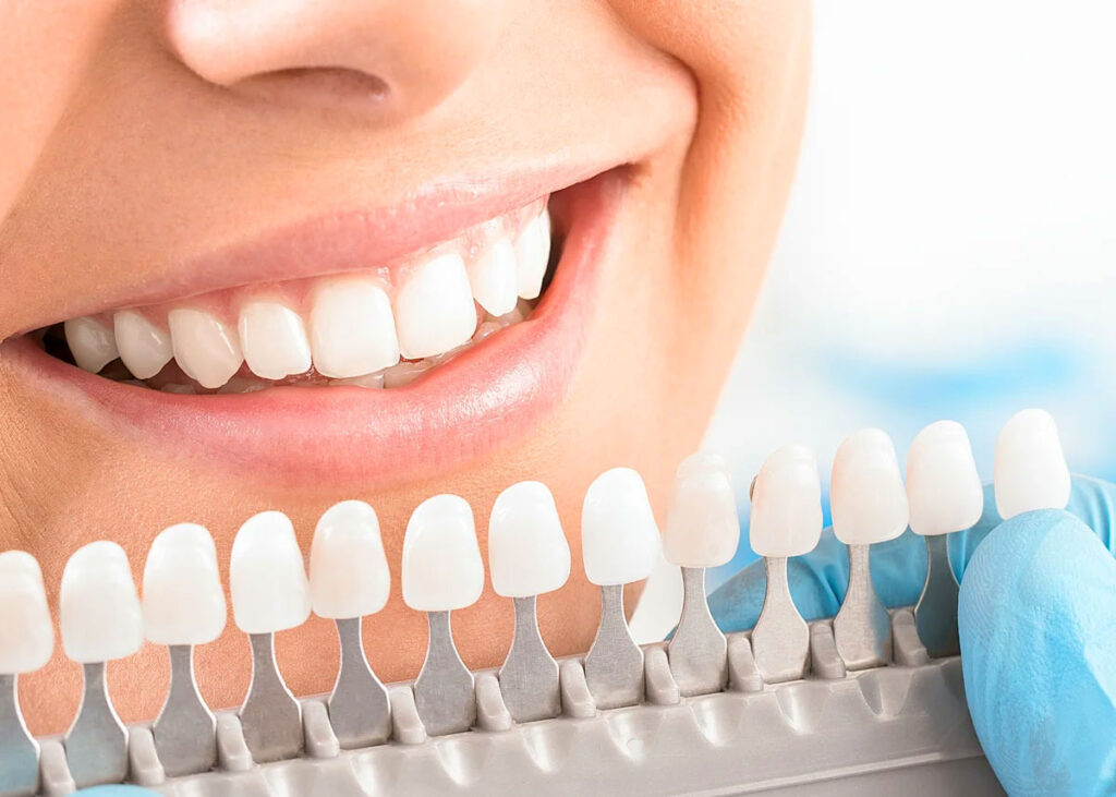 Шкала тонів для оцінки білості зубів