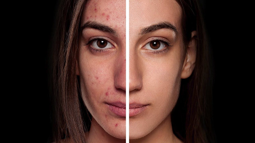 Ультразвуковая чистка лица – эффект до и после