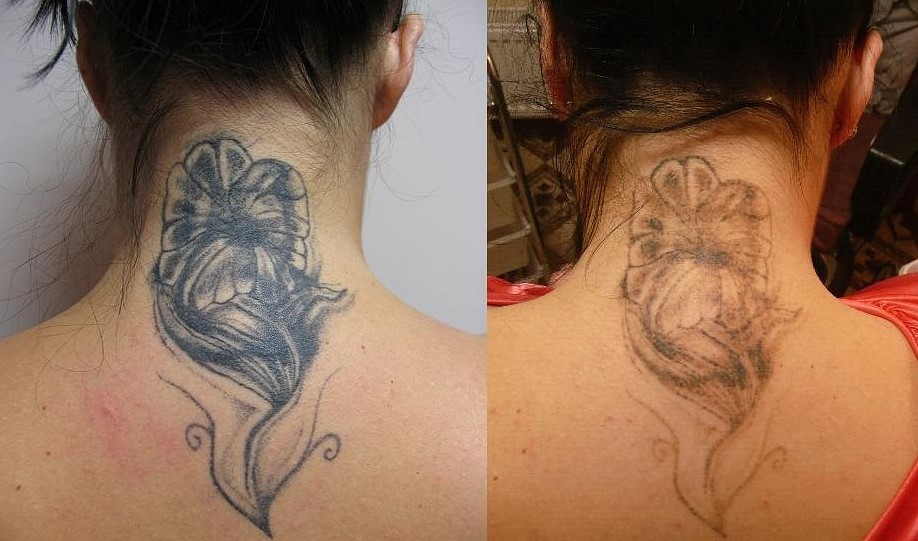 Фото до и после одного посещения лазерного удаления тату