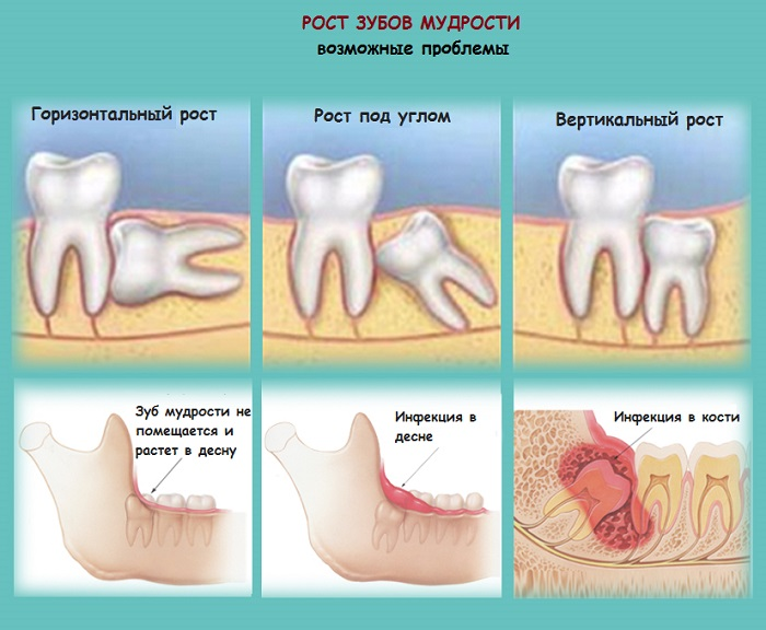 Стоматолог на осмотре определяет обязательно ли удалять зубы мудрости