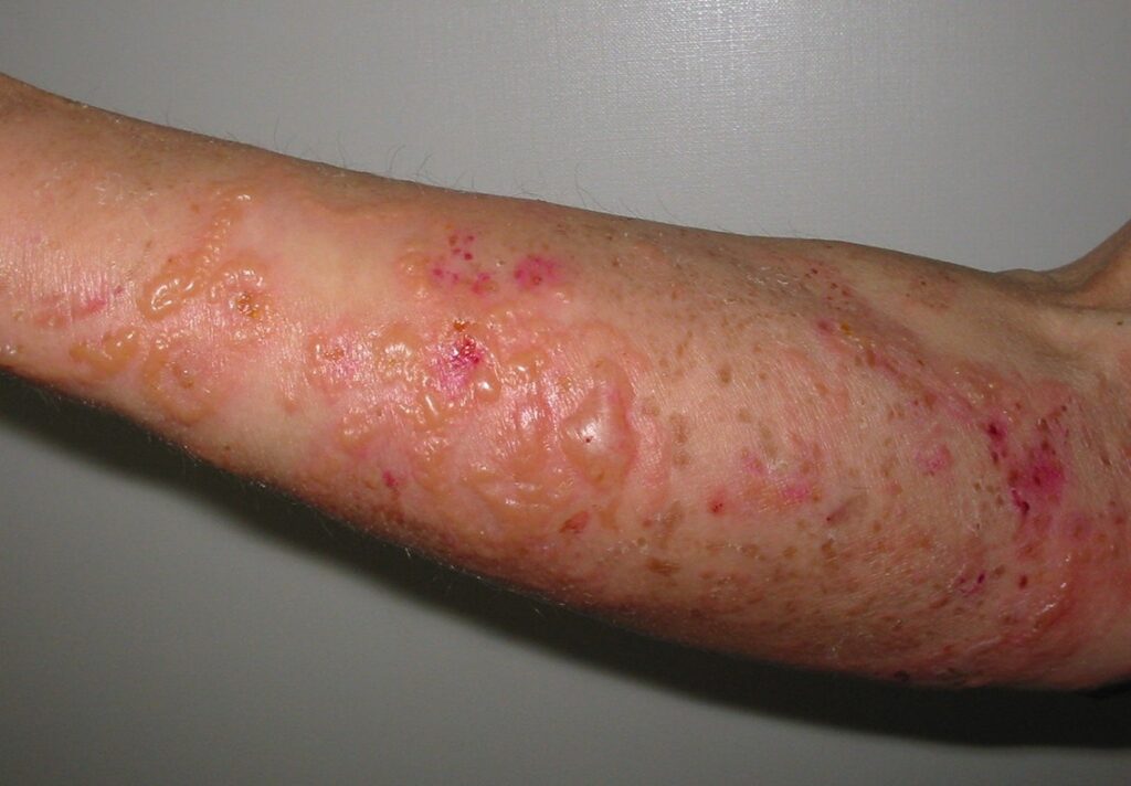 Герпетиформний дерматит на руці