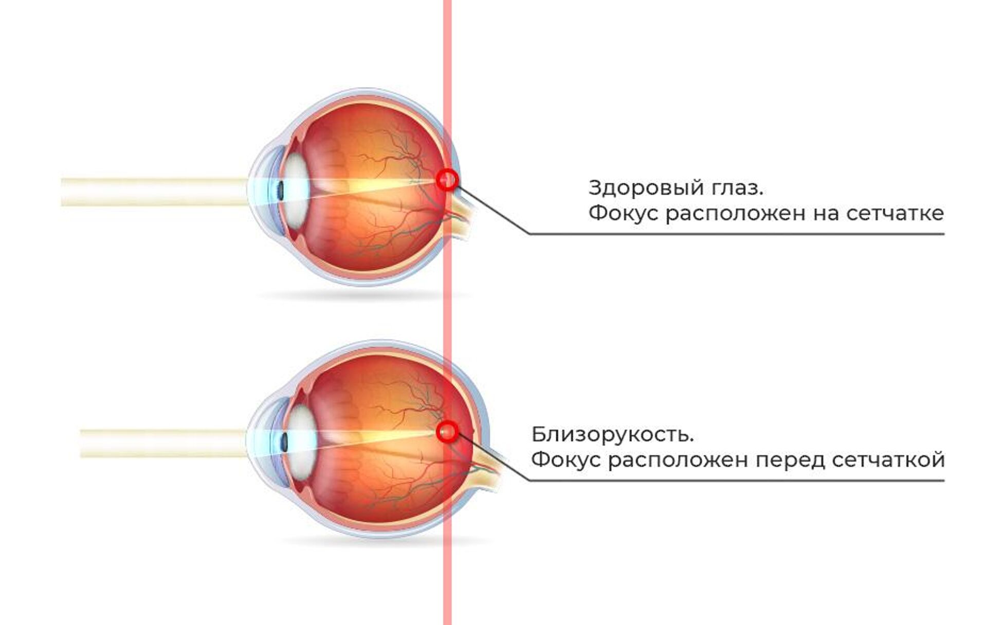 Глазное зрение 1. Близорукость (истинная и ложная формы патологии). Миопия фокус перед сетчаткой. Близорукость глазное яблоко удлиняется. Удлиненное глазное яблоко при близорукости.