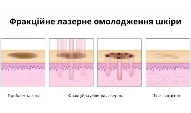 Фракційне лазерне омолодження