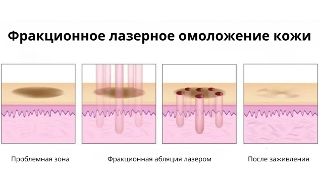 Фракционное лазерное омоложение